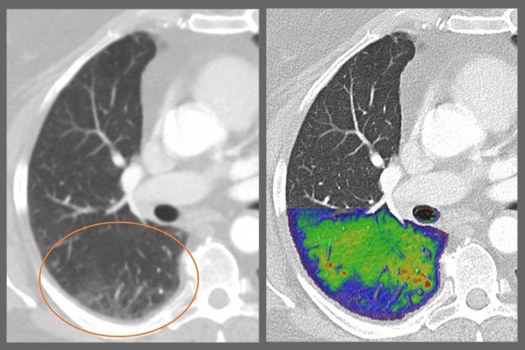 Middle and inner ear – conventional ct technology (left), with...