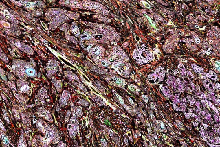 Zoom of Pancreatic ductal adenocarcinoma tissue section imaged with Cell DIVE...