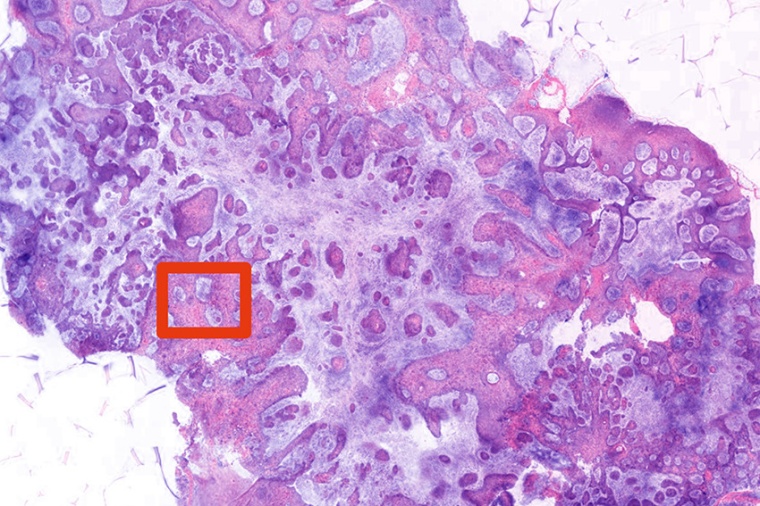 Tissue biopsied with a novel imaging system based on 2-photon fluorescence...