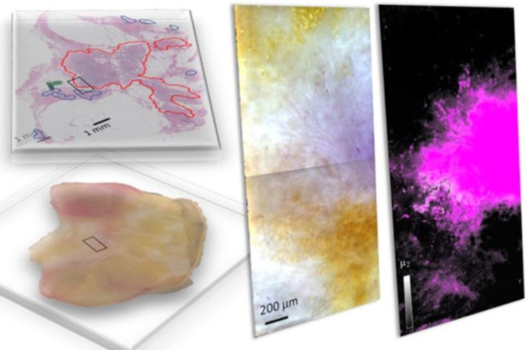 Freshly dissected tissue (lower l.) and its pathology-prepared slide with...